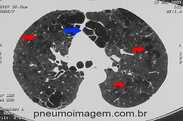 ESTIMULA��O EL�TRICA NEUROMUSCULAR MELHORA O DESEMPENHO EM DPOC